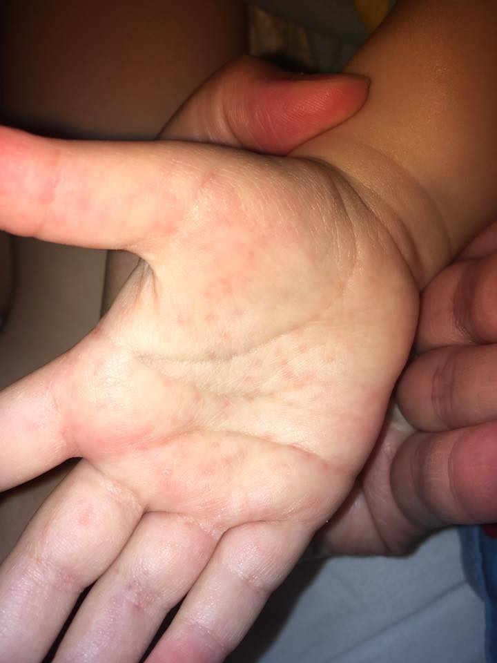 a kéz kezdeti tünetei